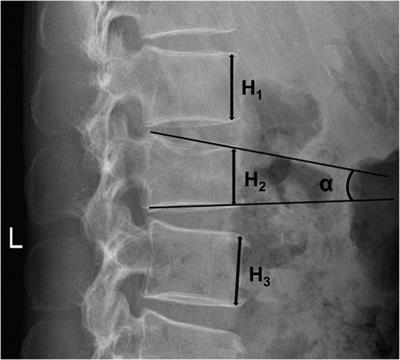 Comparison of pedicle screw fixation by four different posterior approaches for the treatment of type A thoracolumbar fractures without neurologic injury